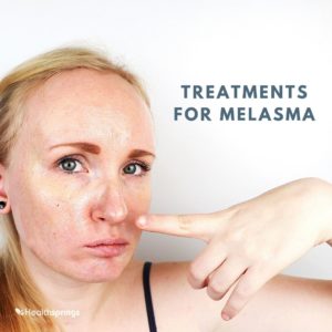 Causes of Melasma
