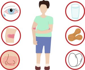 Symptoms of a Food Allergy
